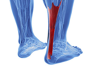Achilles tendon treatment in the Arapahoe County, CO: Littleton, Englewood; Denver County, CO:  Denver;  Jefferson County, CO: Lakewood and Douglas County: Lone Tree, Roxborough Park, Parker, Castle Pines areas