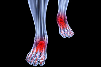 Arthritic foot care in the Arapahoe County, CO: Littleton, Englewood; Denver County, CO:  Denver;  Jefferson County, CO: Lakewood and Douglas County: Lone Tree, Roxborough Park, Parker, Castle Pines areas