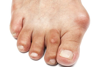 Bunions treatment in the  Littleton, CO 80120 area