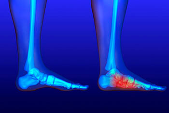 flat feet treatment in the Arapahoe County, CO: Littleton, Englewood; Denver County, CO:  Denver;  Jefferson County, CO: Lakewood and Douglas County: Lone Tree, Roxborough Park, Parker, Castle Pines areas