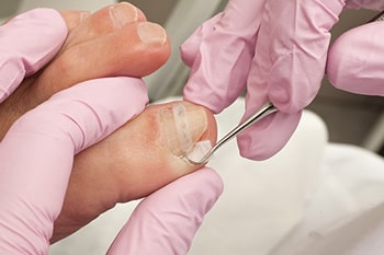 Ingrown toenail treatment in the Arapahoe County, CO: Littleton, Englewood; Denver County, CO:  Denver;  Jefferson County, CO: Lakewood and Douglas County: Lone Tree, Roxborough Park, Parker, Castle Pines areas