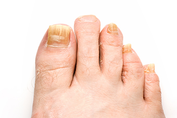 Toenail fungus treatment in the Arapahoe County, CO: Littleton, Englewood; Denver County, CO:  Denver;  Jefferson County, CO: Lakewood and Douglas County: Lone Tree, Roxborough Park, Parker, Castle Pines areas