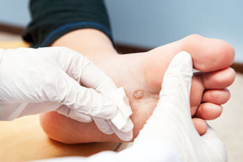 Warts treatment in the Arapahoe County, CO: Littleton, Englewood; Denver County, CO:  Denver;  Jefferson County, CO: Lakewood and Douglas County: Lone Tree, Roxborough Park, Parker, Castle Pines areas