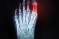 Treatment Options for Broken Toes